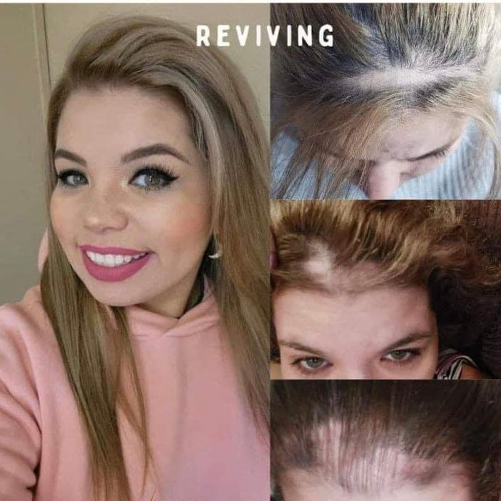 Tratamiento Capilar para la Caída de Cabello